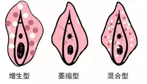 外阴白斑能治好吗?