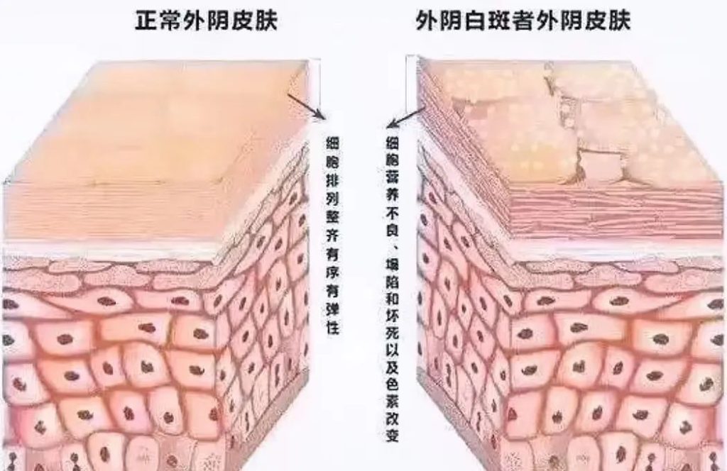 外阴白斑患者为什么会脱屑
