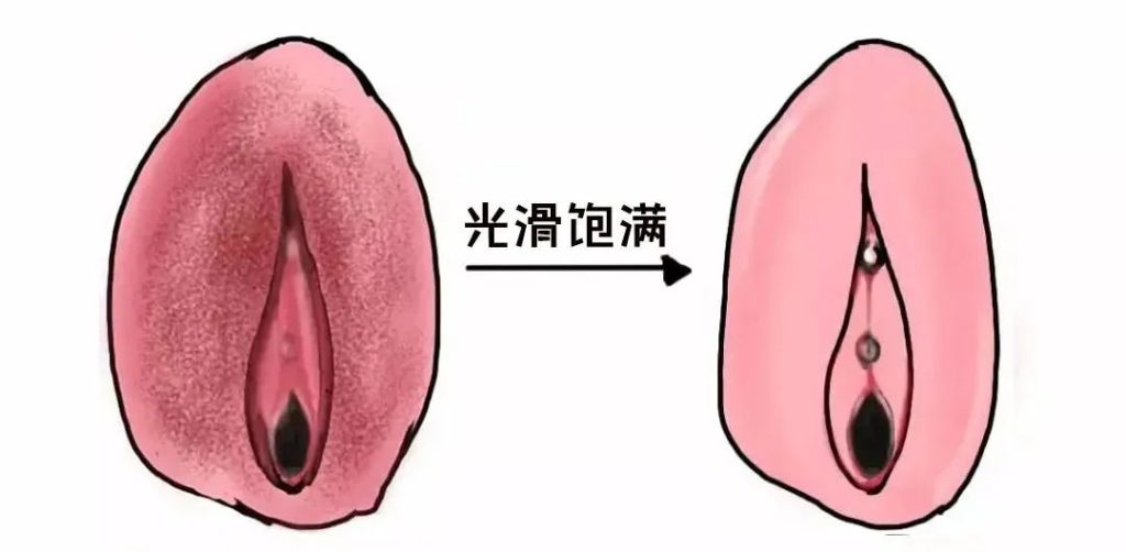 外阴白斑好转的迹象有哪些?