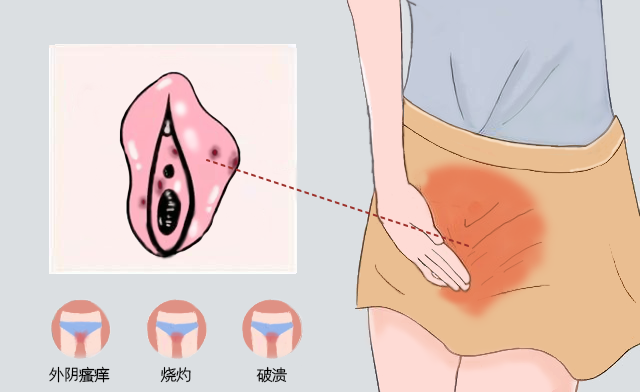 女性的阴道炎和外阴白斑疾病不同之处有哪些?