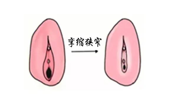 得了外阴白斑后外阴会变成什么颜色?