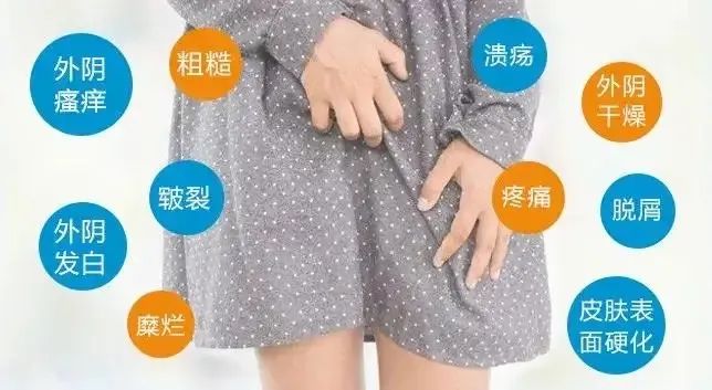 外阴白斑患者该怎么护理?
