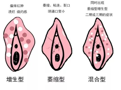 怎么区分外阴白斑和外阴湿疹?