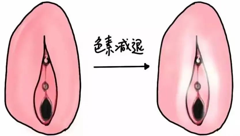 哪些因素会加快外阴白斑的扩散?