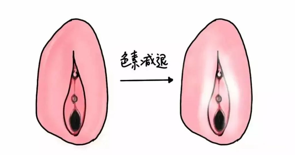 患上外阴白斑病后外阴皮肤颜色一定会变白吗?