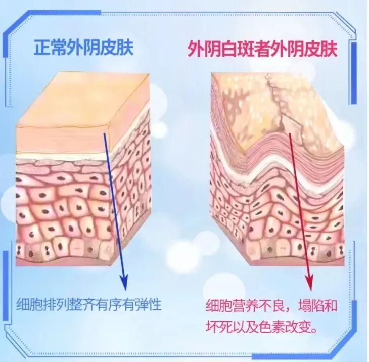 引起外阴白斑的主要病因都有哪些?