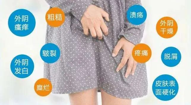 外阴白斑是掉皮屑吗？