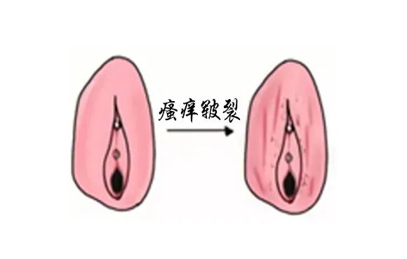 得了外阴白斑后外阴会变成什么颜色?
