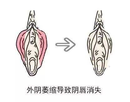 外阴白斑除了灼热,疼痛还有哪些表现?