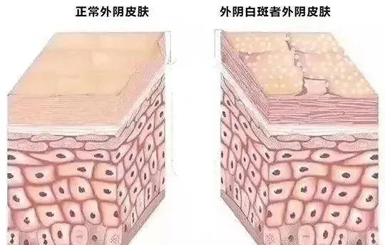 得了外阴白斑后外阴会变成什么颜色?