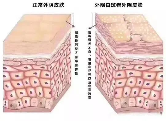 轻度外阴白斑只擦药能治愈吗?