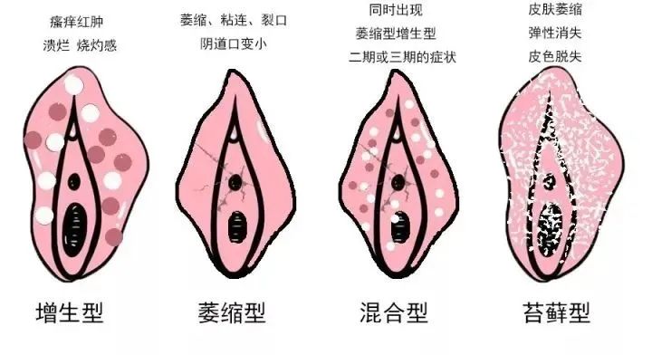 外阴白斑与外阴湿疹有什么不同?