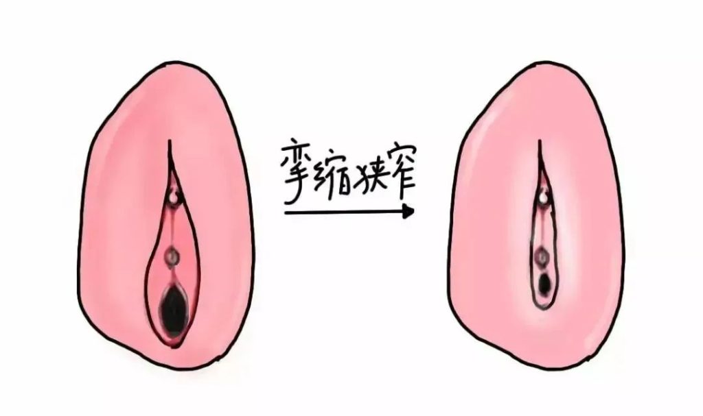 患上外阴白斑病后外阴皮肤颜色一定会变白吗?