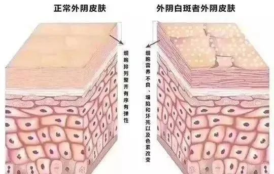 得了外阴白斑二十几年还能治疗好吗?