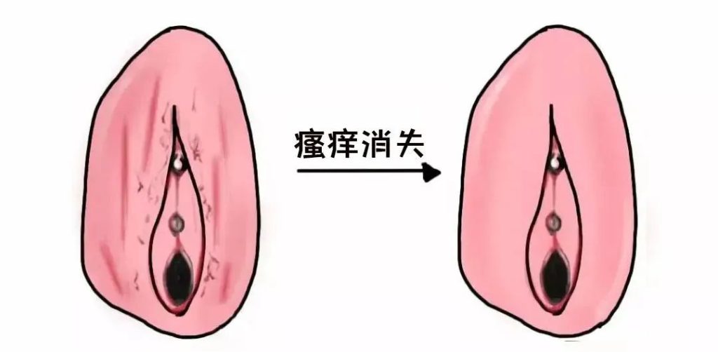 外阴白斑好转的迹象有哪些?