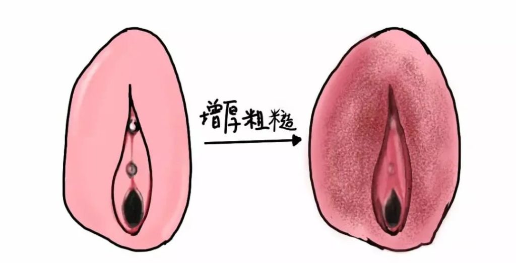 外阴白斑疾病怎么自测?