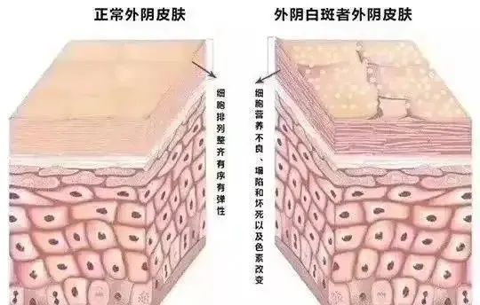 患上外阴白斑后的危害有哪些?