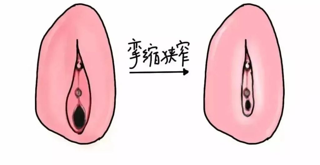 患上外阴白斑是什么颜色
