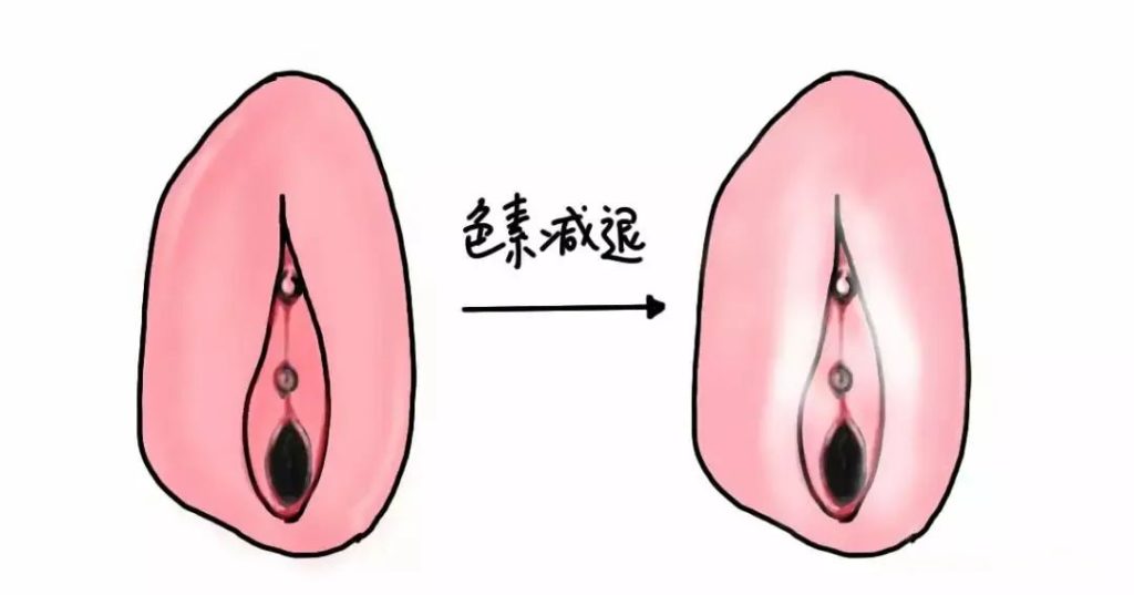 外阴白斑疾病怎么自测?