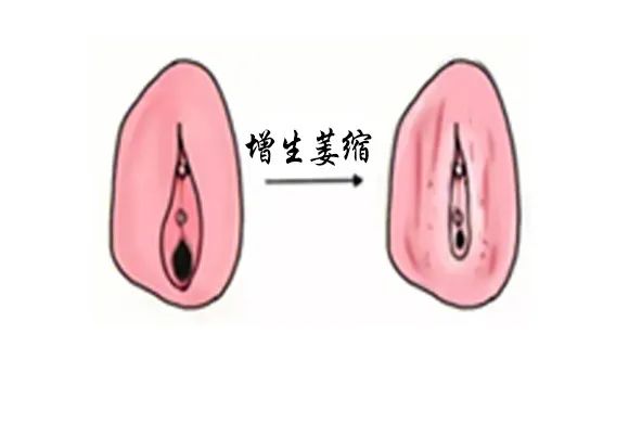 得了外阴白斑后外阴会变成什么颜色?