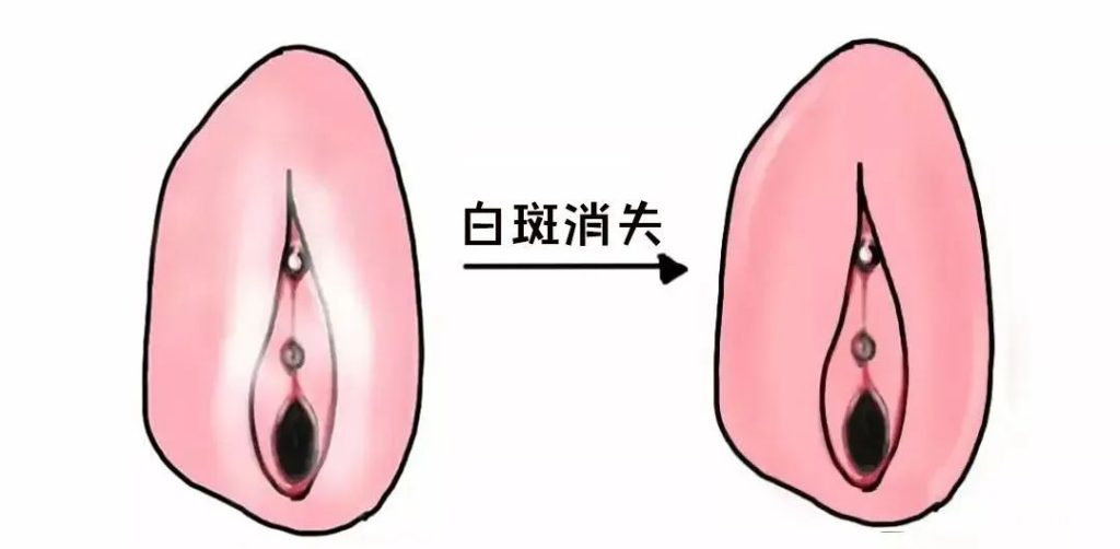 外阴白斑好转的迹象有哪些?
