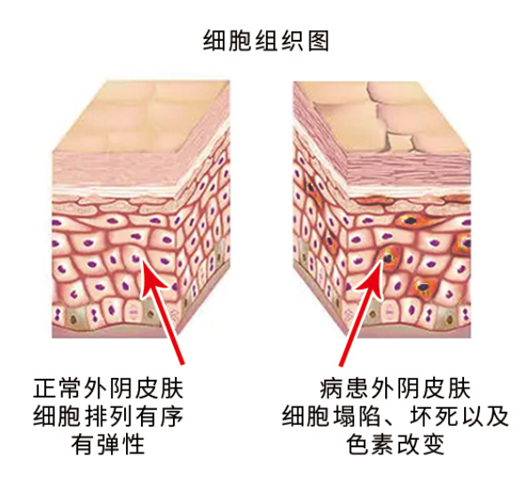 外阴白斑能治好吗?