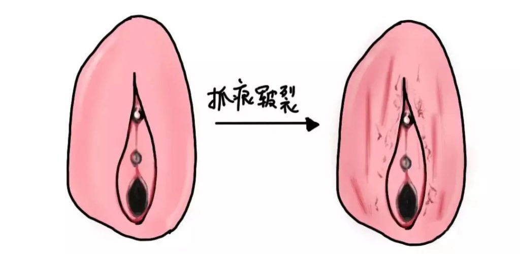 外阴白斑疾病怎么自测?