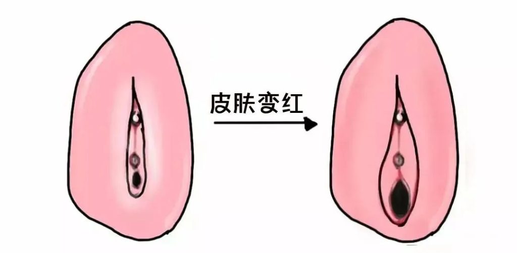 外阴白斑好转的迹象有哪些?